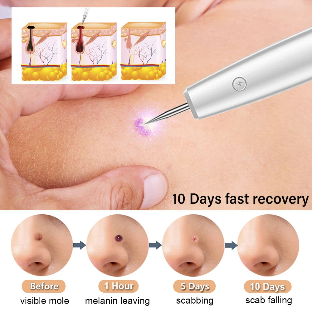 Skin Tag Remover Laser Plasma Pen Dark Spot Mole Wart Remover Pen Electric Tattoo Freckle Nevus Black Spots Skin Tag Removal